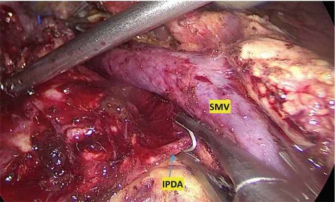 An intraoperative image of the abdomen depicts the inferior pancreatic duodenal artery and a small mesenteric vein close to each other.