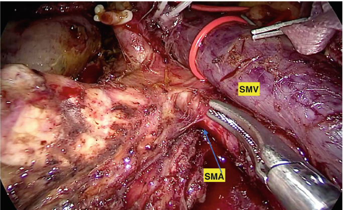 An intraoperative image of the abdomen depicts the small mesenteric artery and a small mesenteric vein close to each other.
