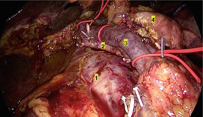 An intraoperative image of the abdomen reveals the inferior vena cava, small mesenteric artery and vein, pancreas, and right hepatic artery all lying in close proximity.
