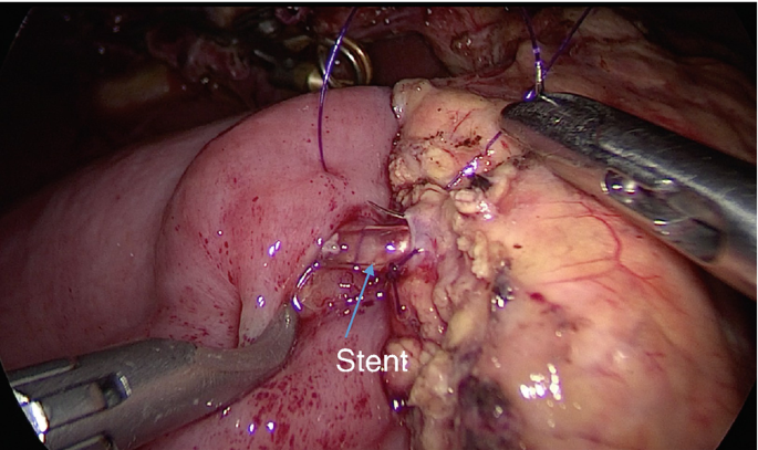 An intraoperative photo of the abdomen with a stent inserted at the junction of the pancreas and a small bowel loop and some suture thread connecting the two is focused.