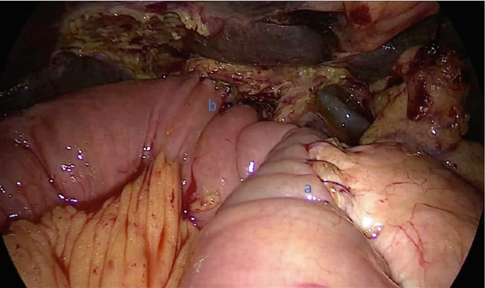 The pancreas, liver, and jejunum are seen in a picture obtained during surgery. The jejunum is a part of the small bowel loop that has been stitched together after the procedure.