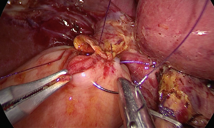 An intraoperative photograph taken during the process of suturing the bowel loop to the liver of the digestive system.