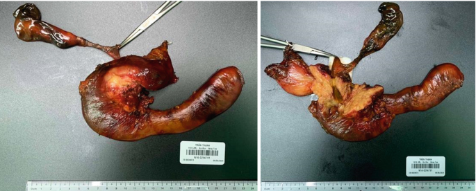Two images of the specimen, which still has a portion of the duodenum and gall bladder connected, are displayed along with a bar code and a measuring scale.