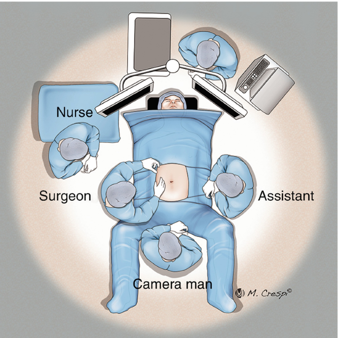 An illustration of an O T setup with the patient surrounded by the cameraman, the surgeon, the nurse, and the assistant.