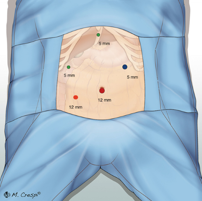 An image of the patient's abdomen depicts the locations of the ports. 2 ports each measure 12 millimeters and 3 ports each measure 5 millimeters.