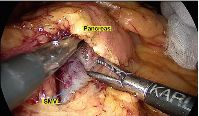 A photograph of the interior of the gut reveals the superior mesenteric vein and pancreas after the superficial layer has been removed.