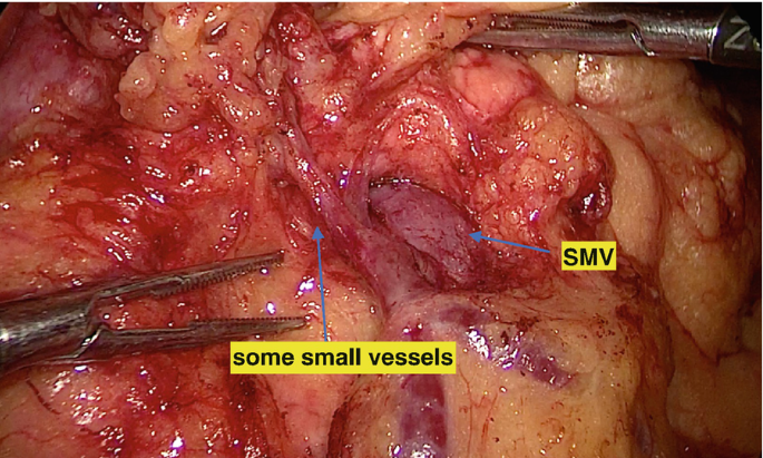 A single mesenteric vein and a few other veins are seen in the intraoperative image of the interior of the abdomen taken after the superficial layer has been retracted.