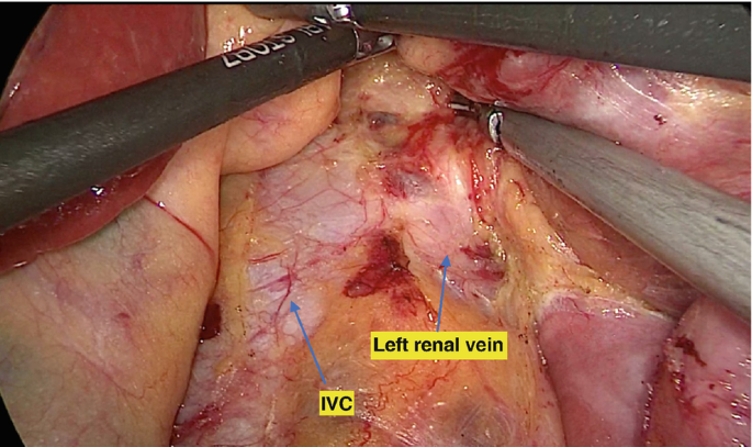 An intraoperative image of the abdomen's interior exposes the left renal vein and inferior vena cava, with 2 clamps holding onto the other organs in one place.