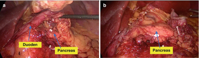 2 intraoperative photos of the abdomen with exposed duodenum and pancreas lying in close proximity.
