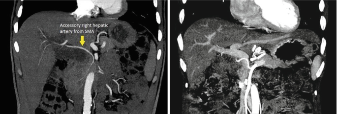 On 2 contrast-enhanced C-T images of the abdomen, an auxiliary right hepatic artery connecting to the small mesenteric artery is visible.