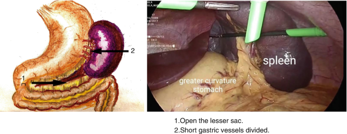 Two pictures. Picture1, a pictorial representation open the lesser sac. Two regions are marked by an arrow. 2 is an internal view of an organ. Picture 2 regions are: marked spleen and greater curvature stomach display the short gastric vessels divided.