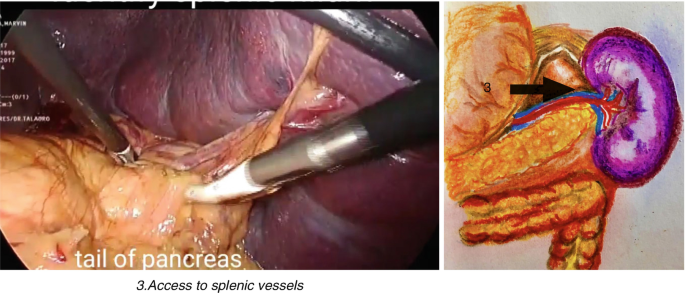 Two pictures. Picture 1 is an internal view of Splenic vessels. A region is marked as the tail of the pancreas. Picture 2 is a representation of Splenic vessels A region is marked by an arrow.
