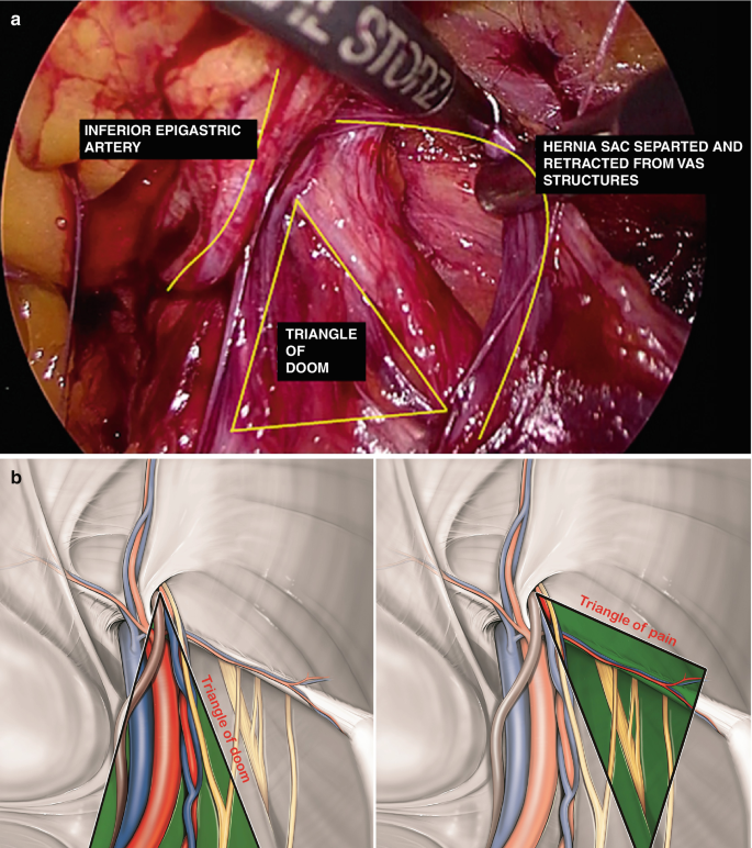 Two images. Image A of an internal view. Two regions labeled inferior epigastric artery, and hernia sac separated and retracted from vas structures. A region marked with a triangle, labeled triangle of doom. Image B, Two graphical representations with regions marked as triangle of doom. The appearance of the content inside the triangle is different.