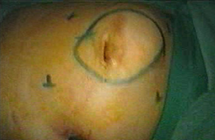 A photo of a mark of a circle on the abdomen.