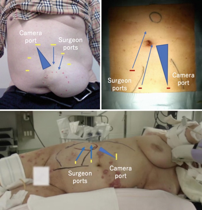 Frontiers  Case Report: 21 Cases of Umbilical Hernia Repair Using a  Laparoscopic Cephalic Approach Plus a Posterior Sheath and Extraperitoneal  Approach