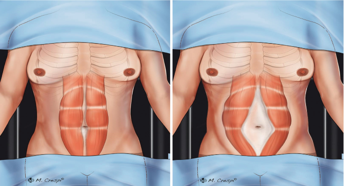 Posterior Plication or Combined Plication of the Recti Diastasis
