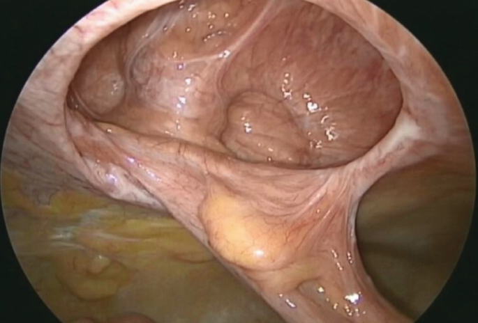 The image of an bowel limb. A portion of the layer is seen pulled from a spot.