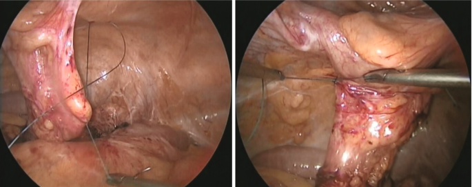 Two images are magnified clearly and it displays the process of the surgery for problem in the bowel limb.