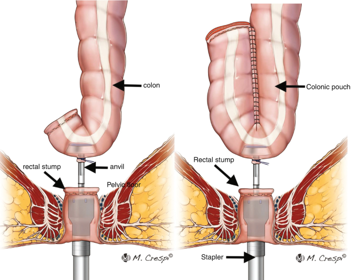 2 graphical diagrams of the colon with anvil, and colon with colonic pouch. 1. The parts of the apparatus attached to the colon are labeled as rectal stump and anvil. 2. The colonic pouch is attached to the colon on the left. The parts of the apparatus attached to the colon are labeled as rectal stump and stapler.