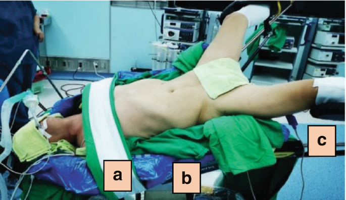 A photo of a patient strapped to the surgical table with a chest strap. His legs are apart and put on the leg hold. The parts are labeled as a, b, and c.