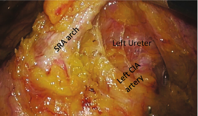 A photomicrograph of the interior abdomen with parts labeled as S R A arch, left ureter, and left C I A artery.