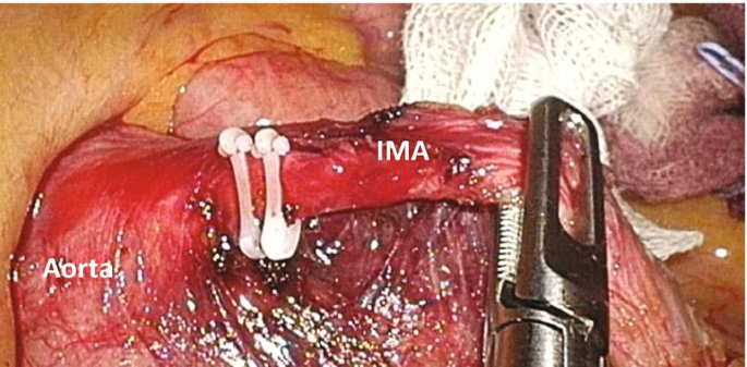 A photomicrograph of the interior abdomen with parts labeled as Aorta and I M A. I M A is held by the clips and clamp.