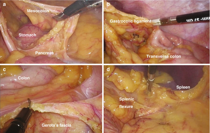 4 photos of the interior abdomen. 1. The parts are labeled as Mesocolon, stomach inside the mesocolon, and pancreas. 2. Gastrocolic ligament and transverse colon. 3. Colon and Gerota's fascia. 4. Splenic flexure and Spleen.