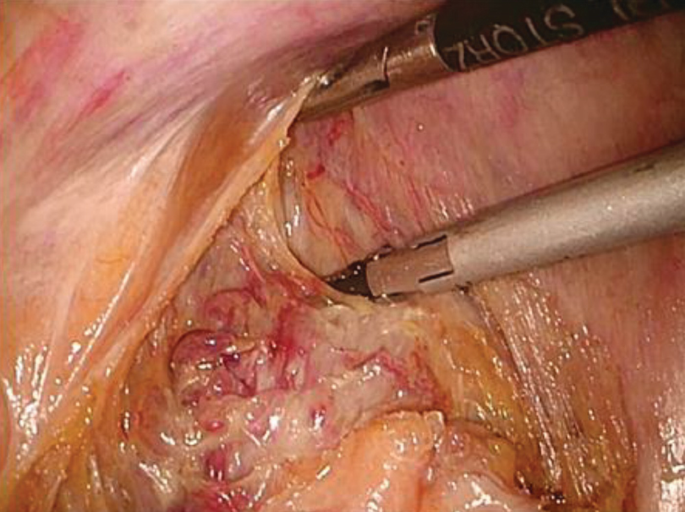 The image from a surgical procedure in which a canal is being opened to access the pelvis using surgical instruments.