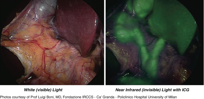 An image of the gallbladder and extrahepatic biliary ducts in white visible light is displayed on the left. The image depicts a close-up view of the veins and gallbladder. Right, the same photo was taken with near-infrared light and I C G demonstrates unclear details of the gallbladder.