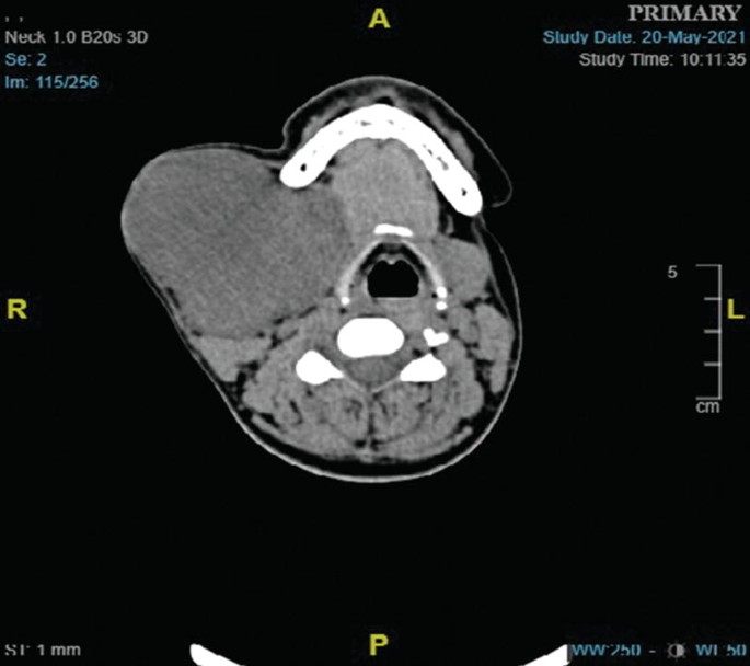 A C T scan of the neck with submandibular gland mass, mandible, and airway.