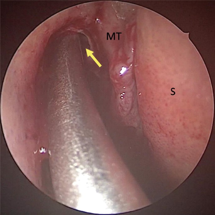 A microscopic view of the frontal recess. It is a muscular tunnel-like structure marked with an up arrow. A metal probe is inserted into the tunnel. The muscular walls on its right and bottom right are labeled M T and S, respectively.