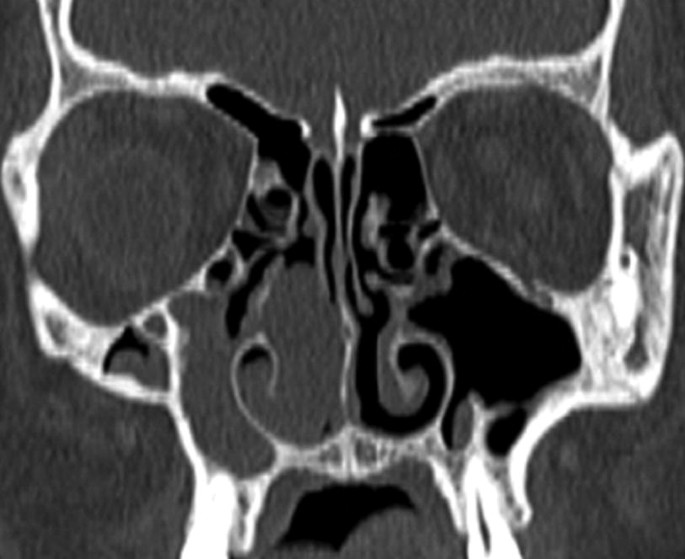 A C T scan of the nasal cavity. The top-left and right sides of the nasal cavity have dark patches. The entire scan has bright outlines for the bony structure with shaded inner and outer compartments.