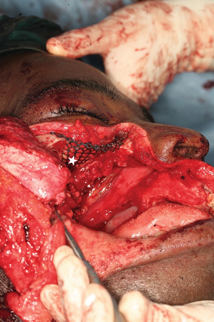 A close-up view of a patient's face. The patient's right cheek is stretched with probes. Below the right eye, it has mesh-like structures.