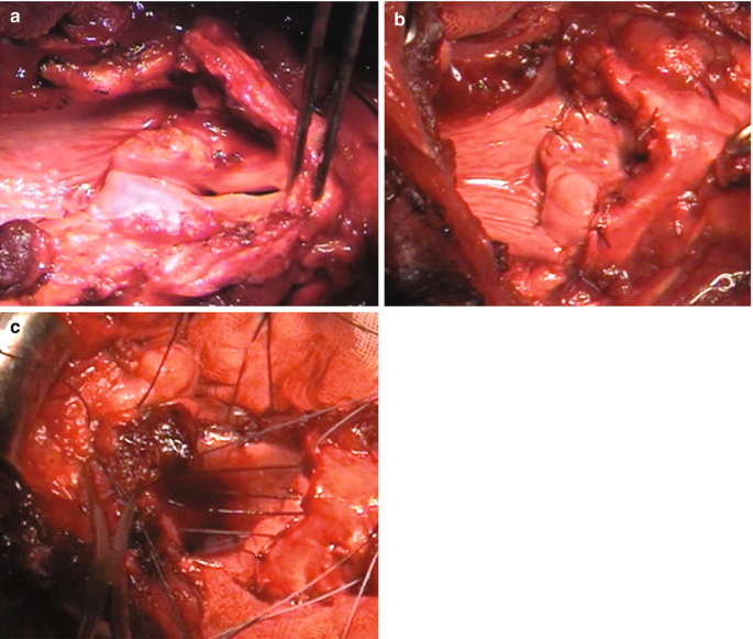 A set of 3 intraoperative photos of the throat region of a patient with surgical tools labeled a to c. A: arytenoid on glottic plane. B: perichondrium sutured to ventricle floor. C: pexy with three single stitches.