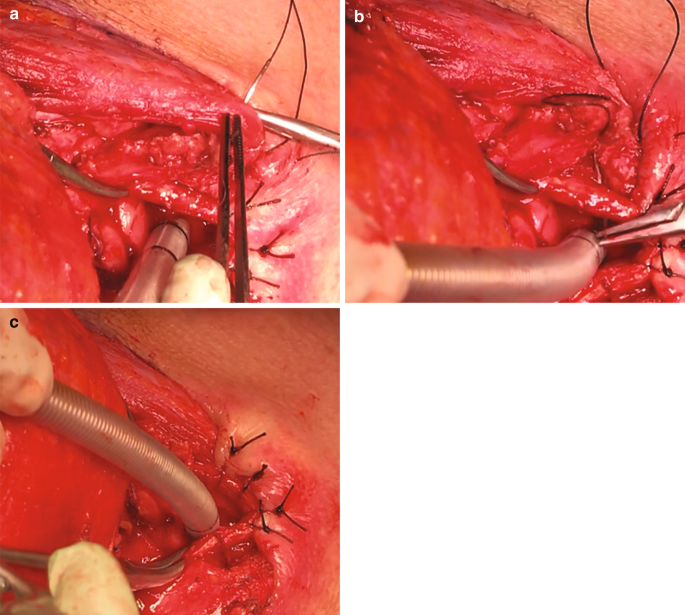 A set of 3 intraoperative photos of the closure of the tracheostomy with a single suture point with surgical tools labeled a to c.