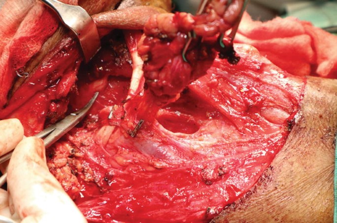 A magnified view of the dissected region of the neck of a patient where the submandibular gland and its nodes are removed using some surgical instruments.