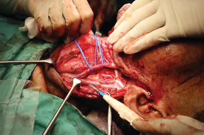 A photograph of the neck dissection of a patient held with some surgical instrument that exposes the branch of I J V.