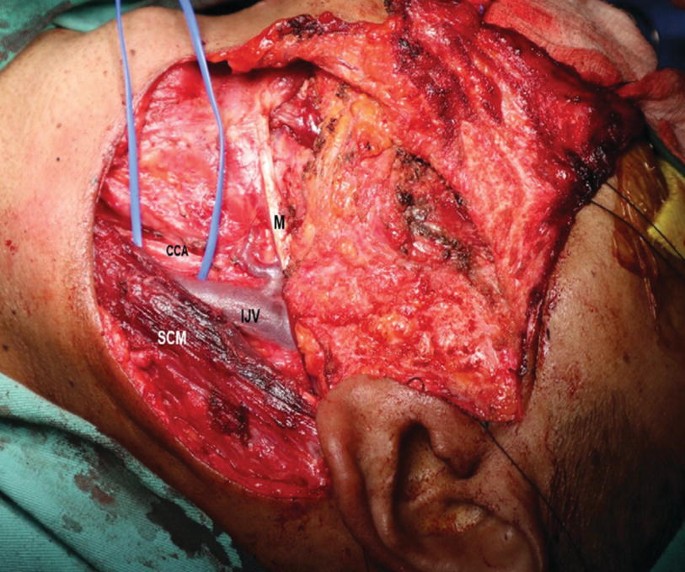 A close-up view of a patient&#x2019;s face dissection. The labels on the dissection are as follows, M, C C A, I J V, and S C M.