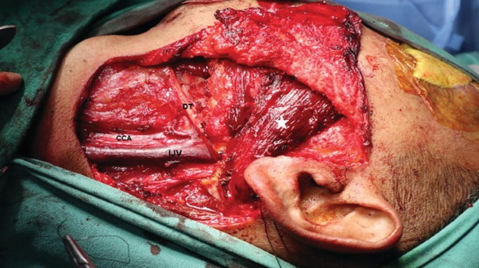 A close-up view of a patient&#x2019;s face dissection. The labels on the dissection are as follows, D T, C C A, and I J V.