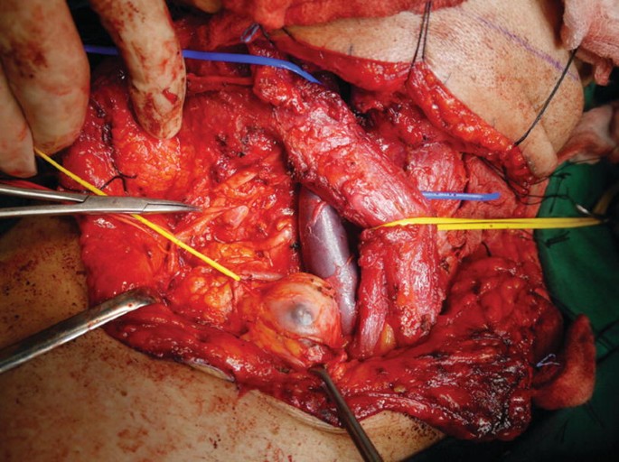 A close-up shot of metastatic nodes in a patient's neck dissection held with surgical tools.