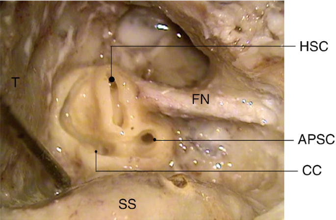 A photo of semicircular canals with labels F N and S S. Different areas are labeled as H S C, A P S C, and C C.