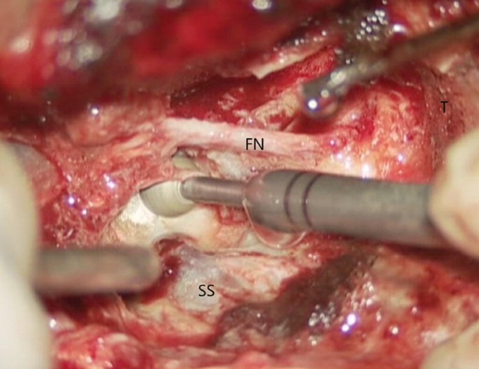 An intraoperative photo of an infratemporal fossa approach with surgical tools. The areas marked are F N and S S.