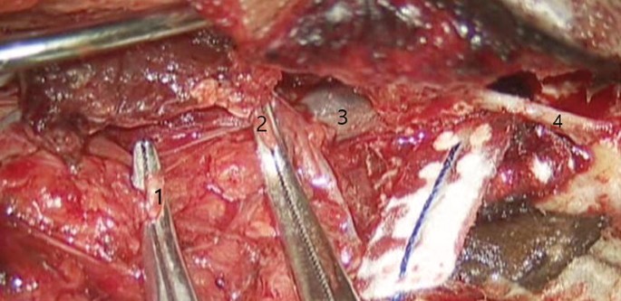 An intraoperative photo of ligature of internal jugular vein with surgical tools. The areas marked are 1, 2, 3, and 4.