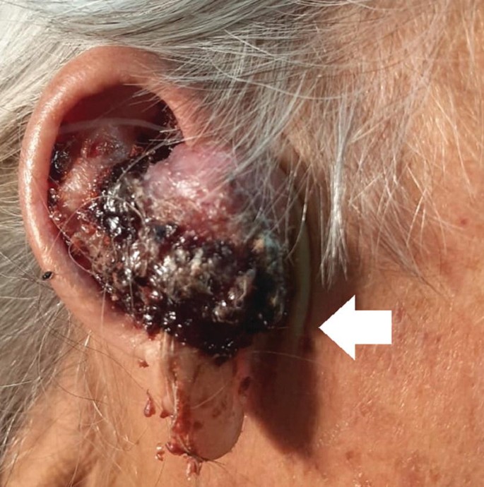 A close-up photo of the ear of a person with squamous cell carcinoma. The arrow indicates the bulged infected part in the ear.