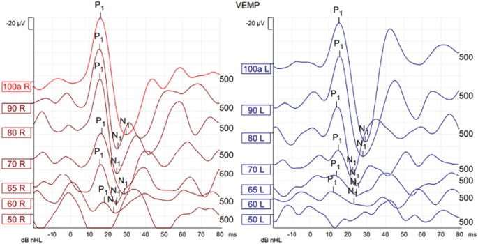 2 V E M P graphs plot negative 20 microvolts versus d B n H L. The graphs have 7 curves each in fluctuating trends. The highest and lowest peaks in all the curves are labeled as P subscript 1 and N subscript 1, respectively.