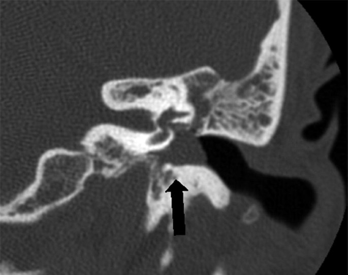 A C T scan of the ear of a patient with different highlighted areas. An arrow points to the middle ear neoplasm.