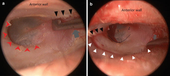 2 photos of an endoscopic view of a human ear with a flap knife in a and a cutting knife in b. Both indicate the anterior wall on top and areas marked by arrows, arrowheads, and numbers 1 and 2.