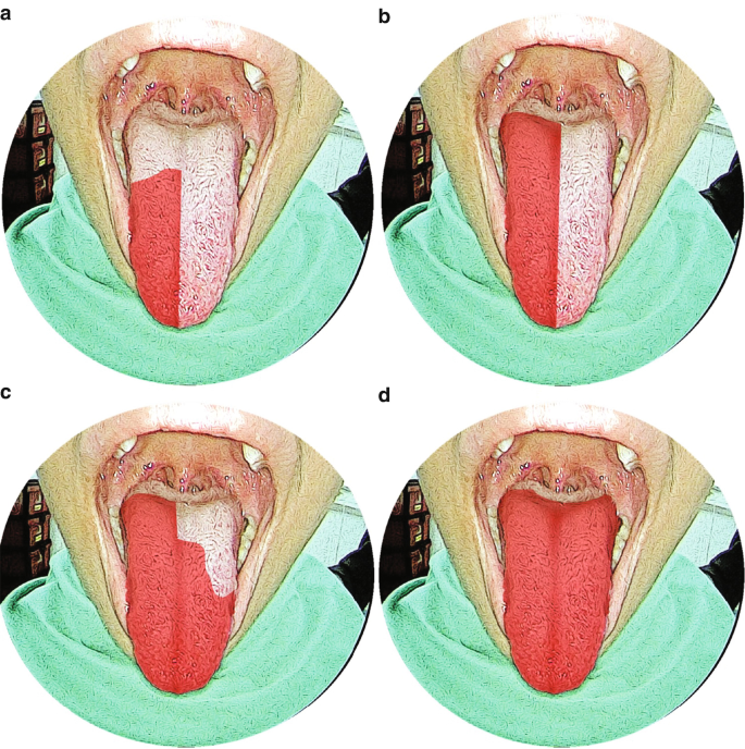 4 images of the tongue. In a, a portion on the right is highlighted. In b the right side is highlighted. In c, the right and a portion of the left, and in d the entire tongue is highlighted.