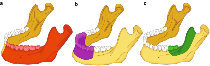 3 illustrations of the mandible. In a the left body up to the condylar is highlighted. In b the marginal area is highlighted. In c the molars and coronoid process are highlighted.