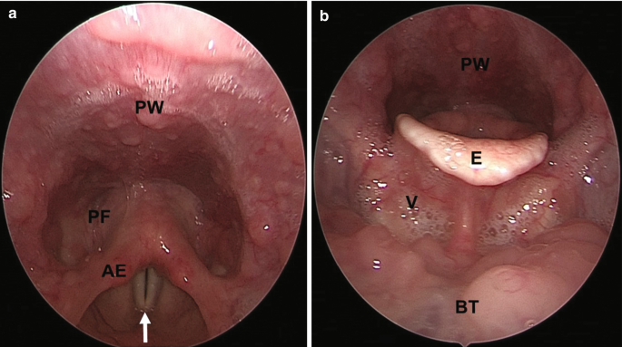 2 endoscopic views of the larynx. The parts of the larynx are marked P W, P F, A E, E, V, and B T.